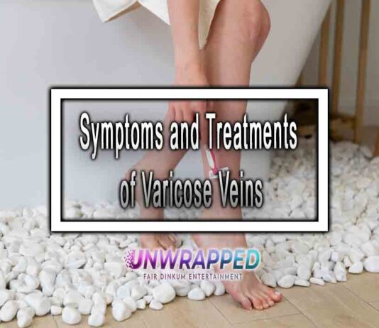 Symptoms and Treatments of Varicose Veins