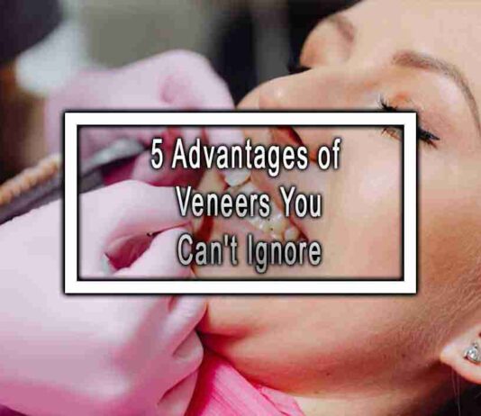 5 Advantages of Veneers You Can’t Ignore