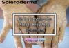 Here's Everything You Need to Know About Scleroderma