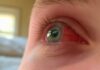 Can I Go to Work with Conjunctivitis? A Comprehensive Guide