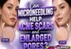 Can Microneedling Help Acne Scars and Enlarged Pores?